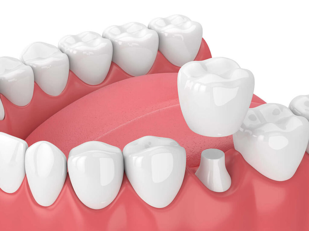 illustration of a dental crown