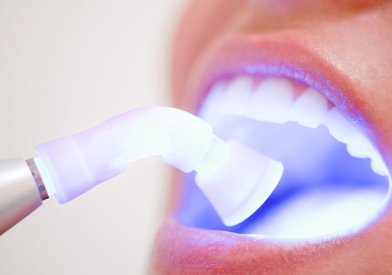 laser teeth whitening tool inside a patients mouth